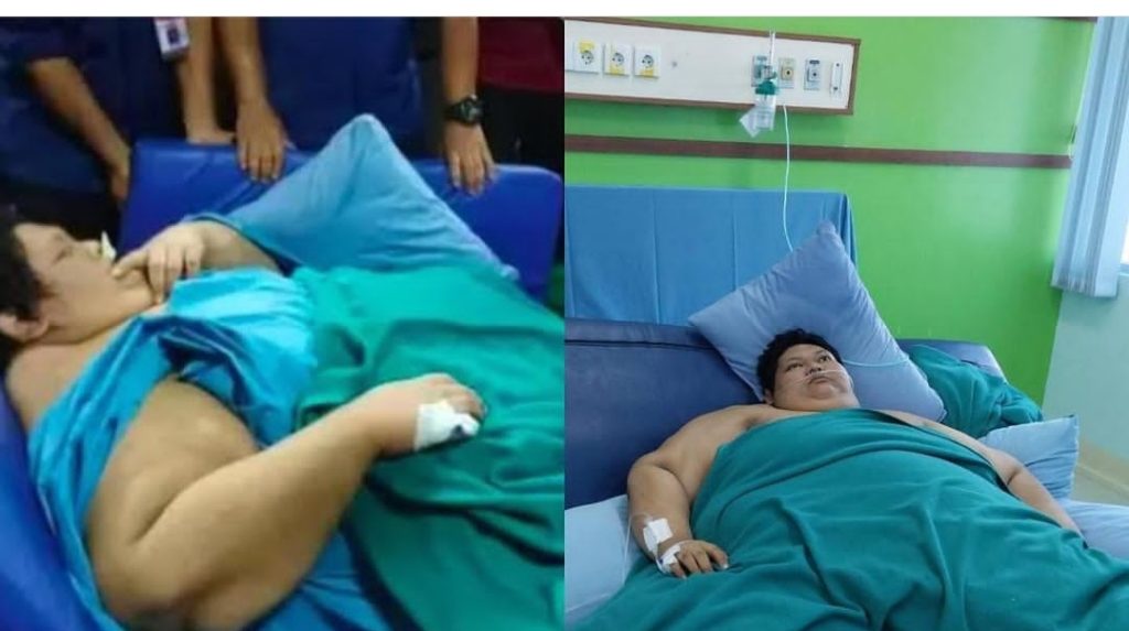 Fajri Pria Obesitas 300 Kg Meninggal Dunia di RSCM